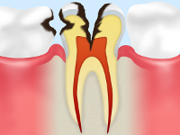 C3　後期のむし歯