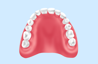 レジン床義歯